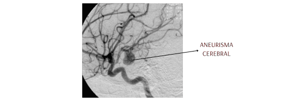 Imagem de aneurisma cerebral